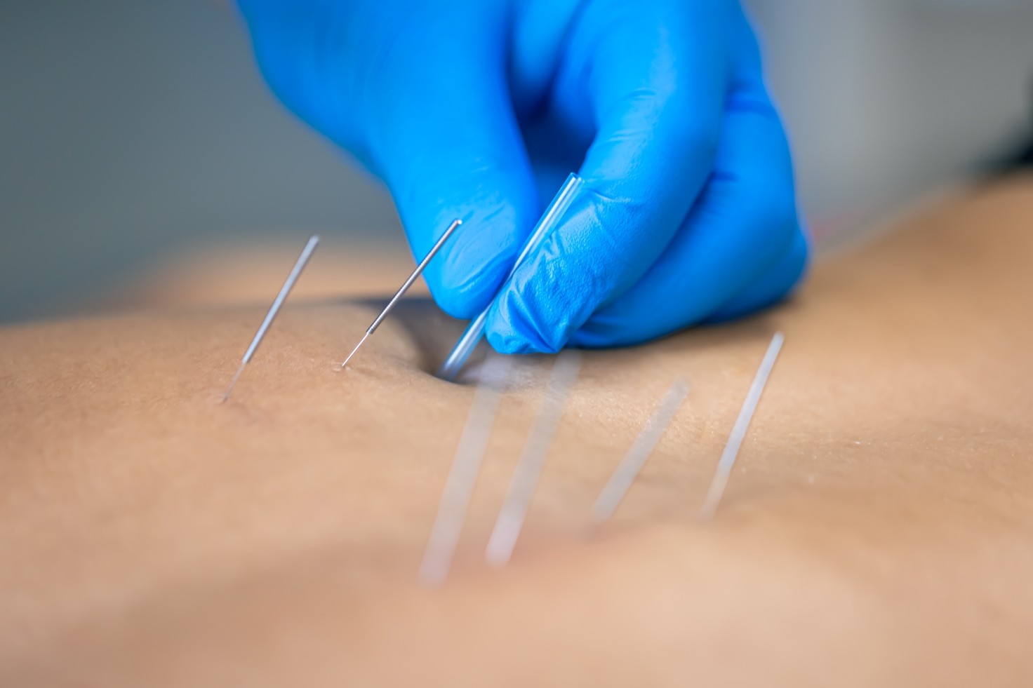 Dry needling vs acupuncture comparison