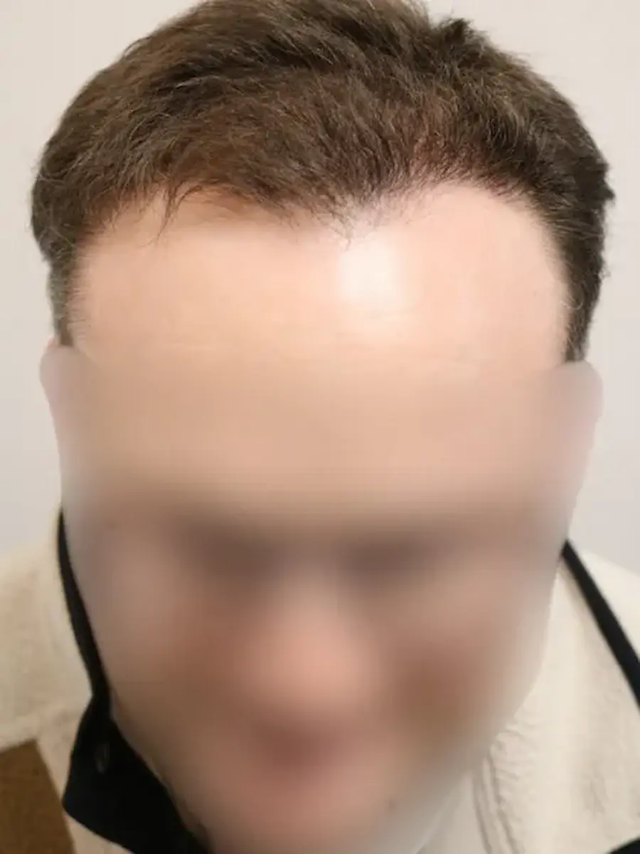 After hair transplant – Stuart's FUE Hair Transplant Result