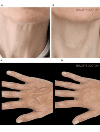 손등·턱선 볼륨에 효과적인 레디어스 필러, 왜 눈가 시술은 피해야 할까?