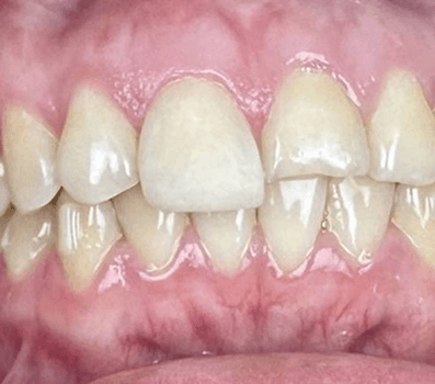 Cosmetic Bonding - Composite Veneer