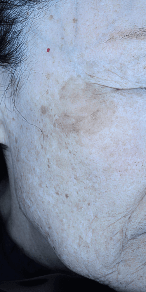 Pigmentation - Before