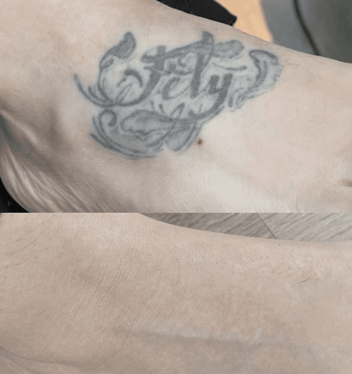 Scalp Micropigmentation Schweiz