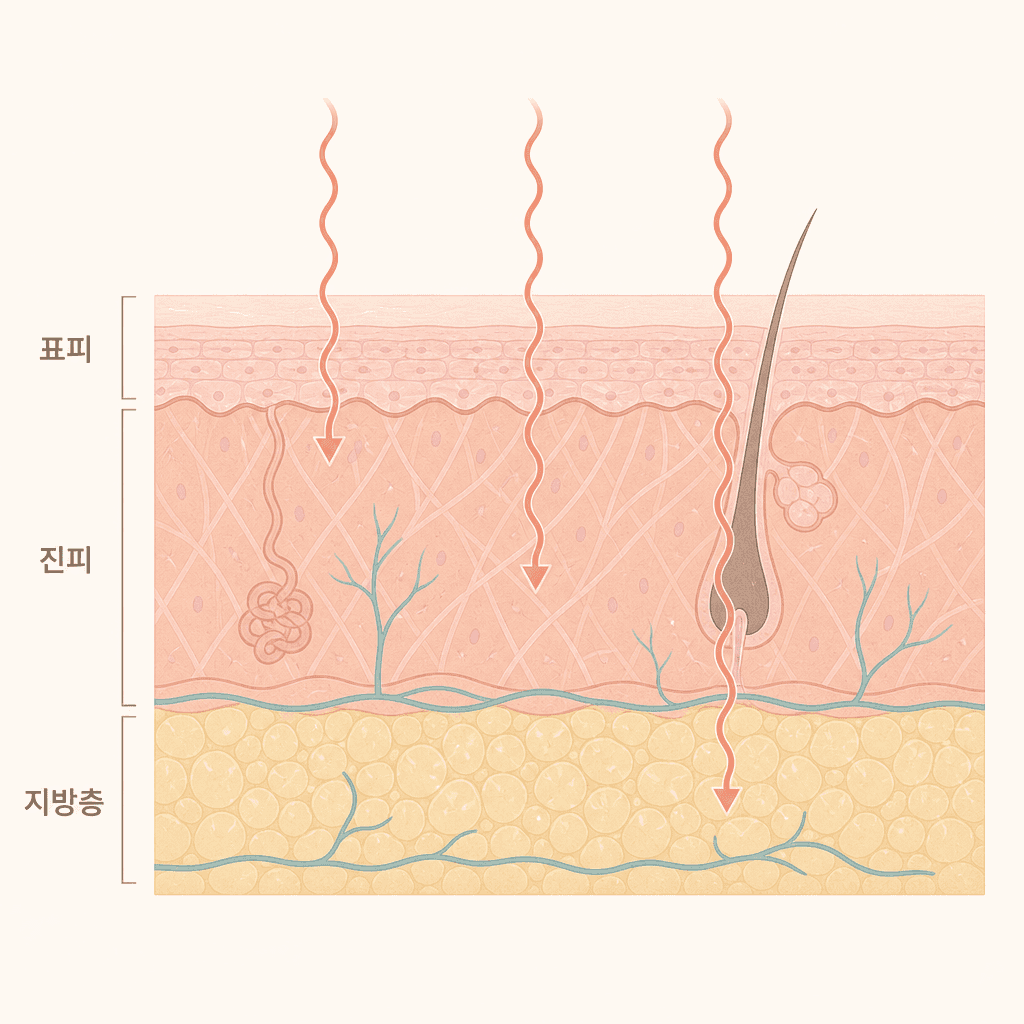 표피·진피·지방층에 열이 닿는 단면 모습