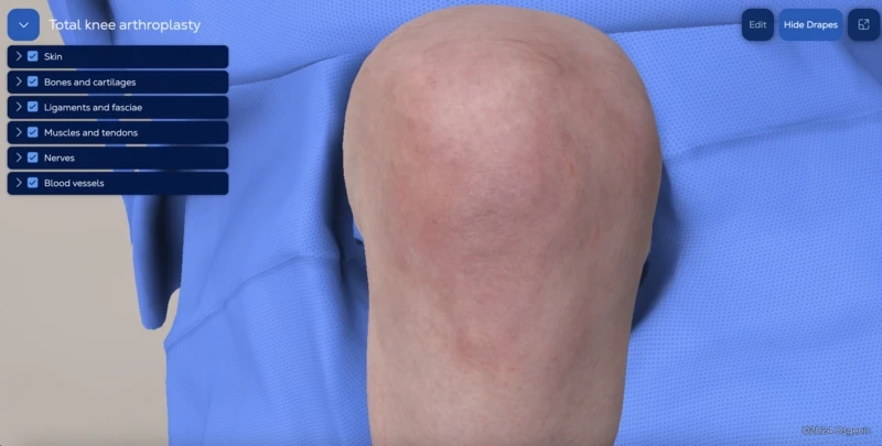 Total knee arthroplasty (mechanical alignment)