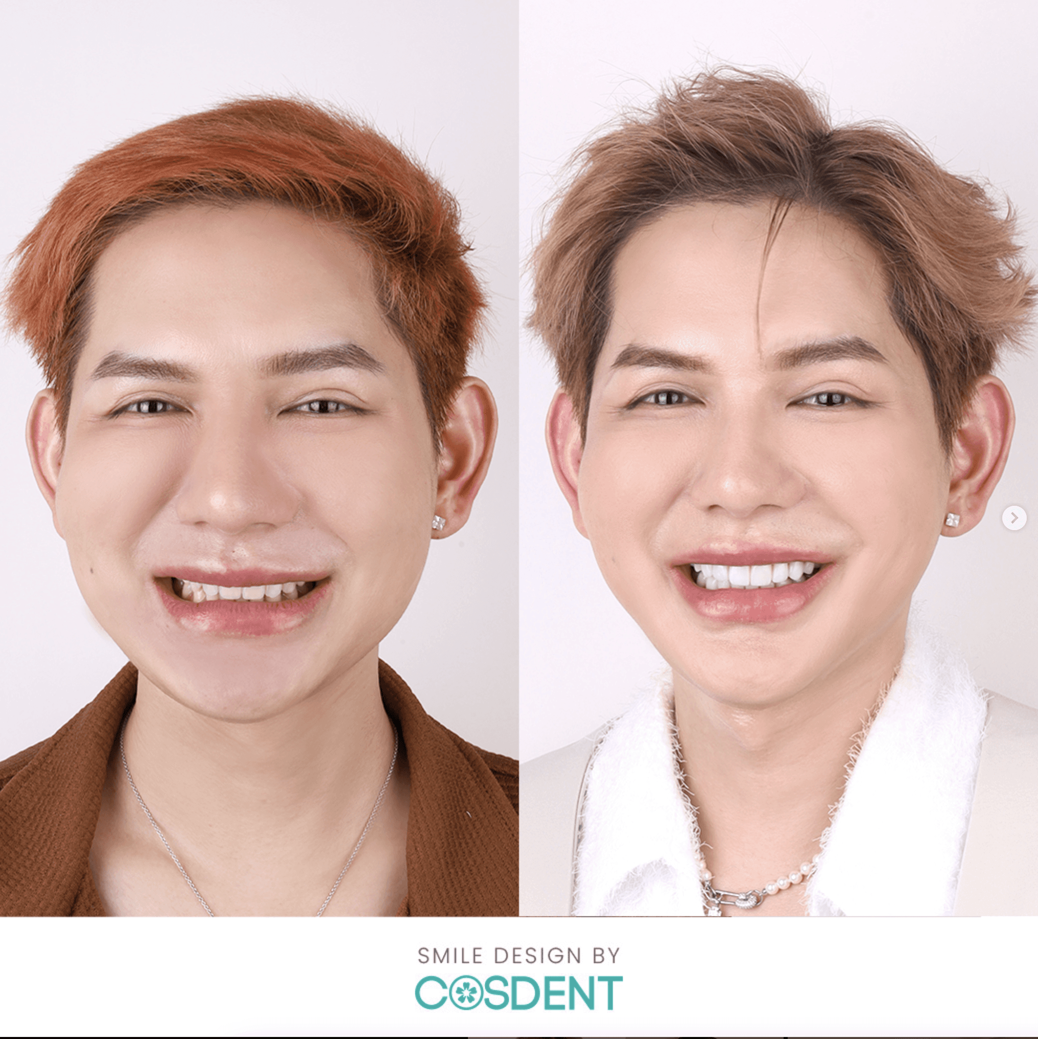 เคสทำวีเนียร์ หมอฝน cosdent