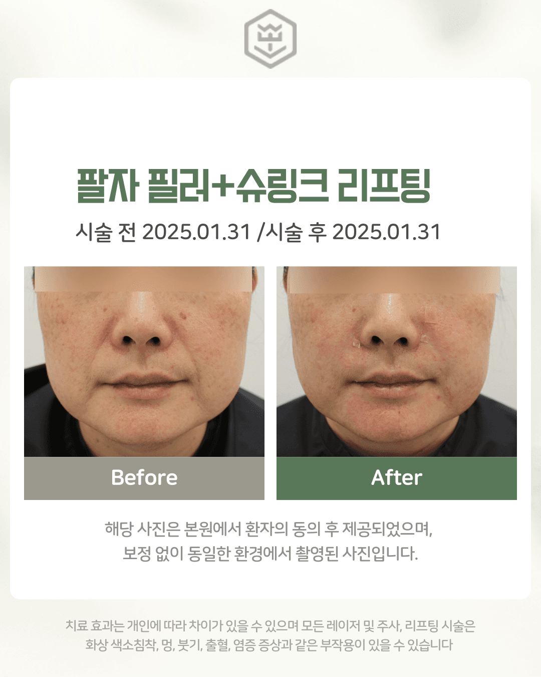 팔자필러+슈링크 리프팅