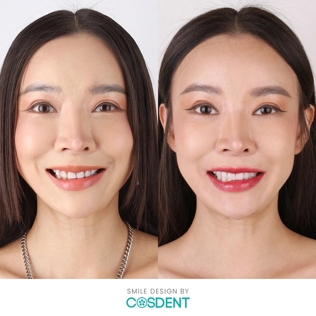 รีวิวออกแบบรอยยิ้ม ที่ cosdent smile design