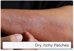 Dry, itchy patches