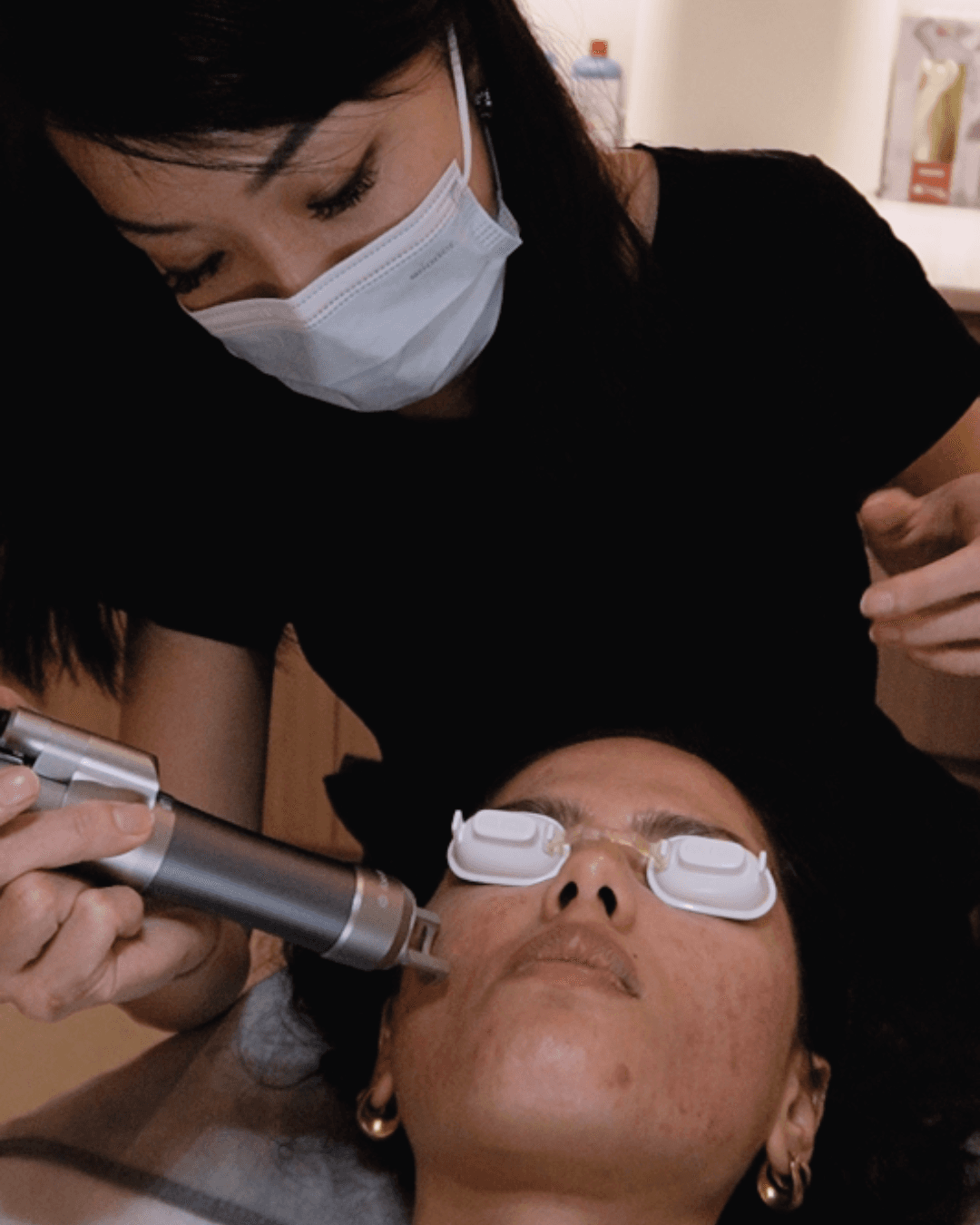 Acne scar removal treatments in Singapore.