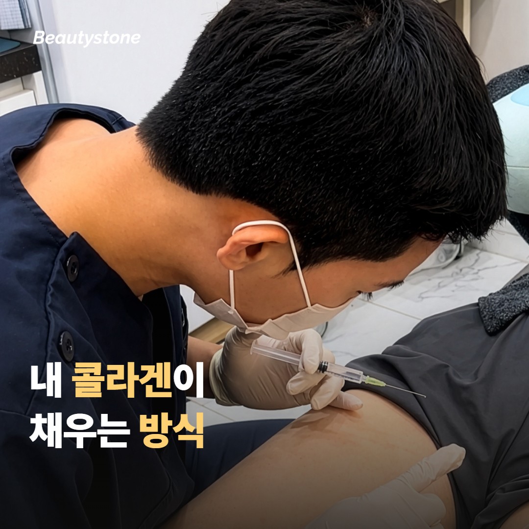 스컬트라 볼륨이 오래 간다는 게 어떤 의미인지부터