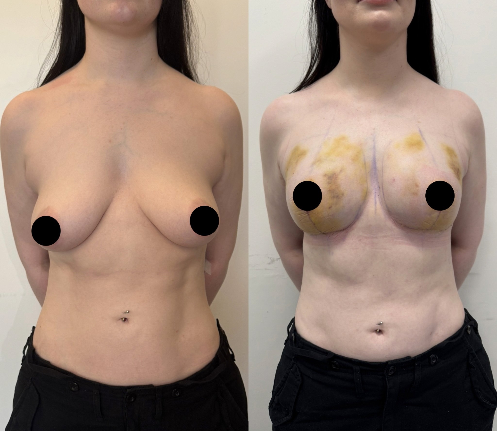 breast lift and fat injection before after front view