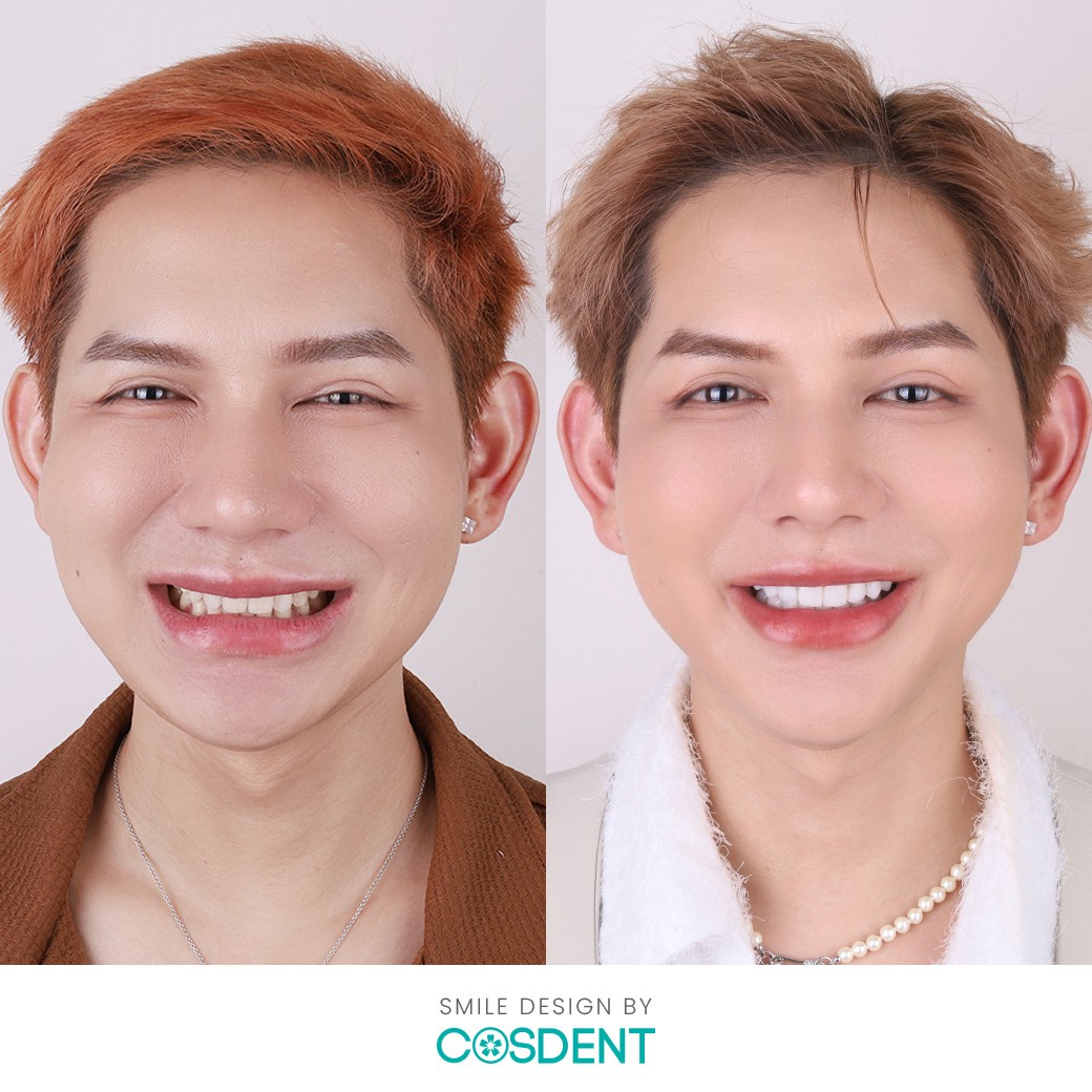 ผลงานการเปลี่ยนแปลงรอยยิ้มที่ COSDENT