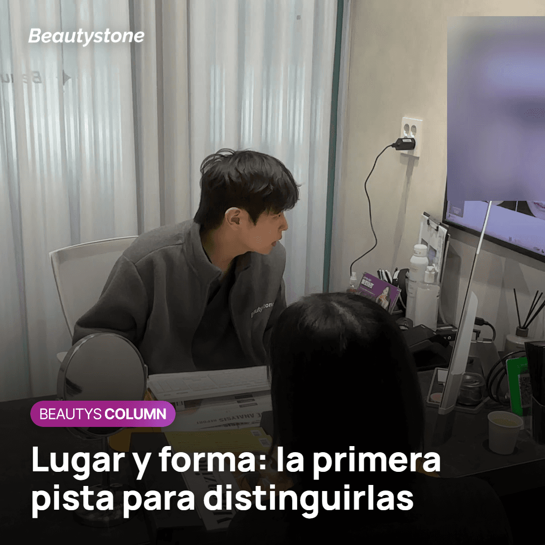 Distinguir melasma, pecas y léntigo solar por su lugar y su forma