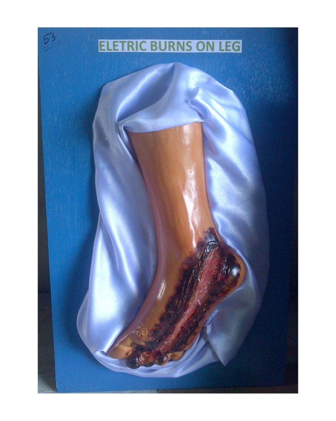 Electric Burns on Leg