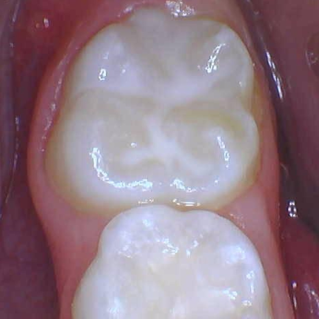 Close-up view of a protective dental sealant applied to a child’s molar to prevent cavities.
