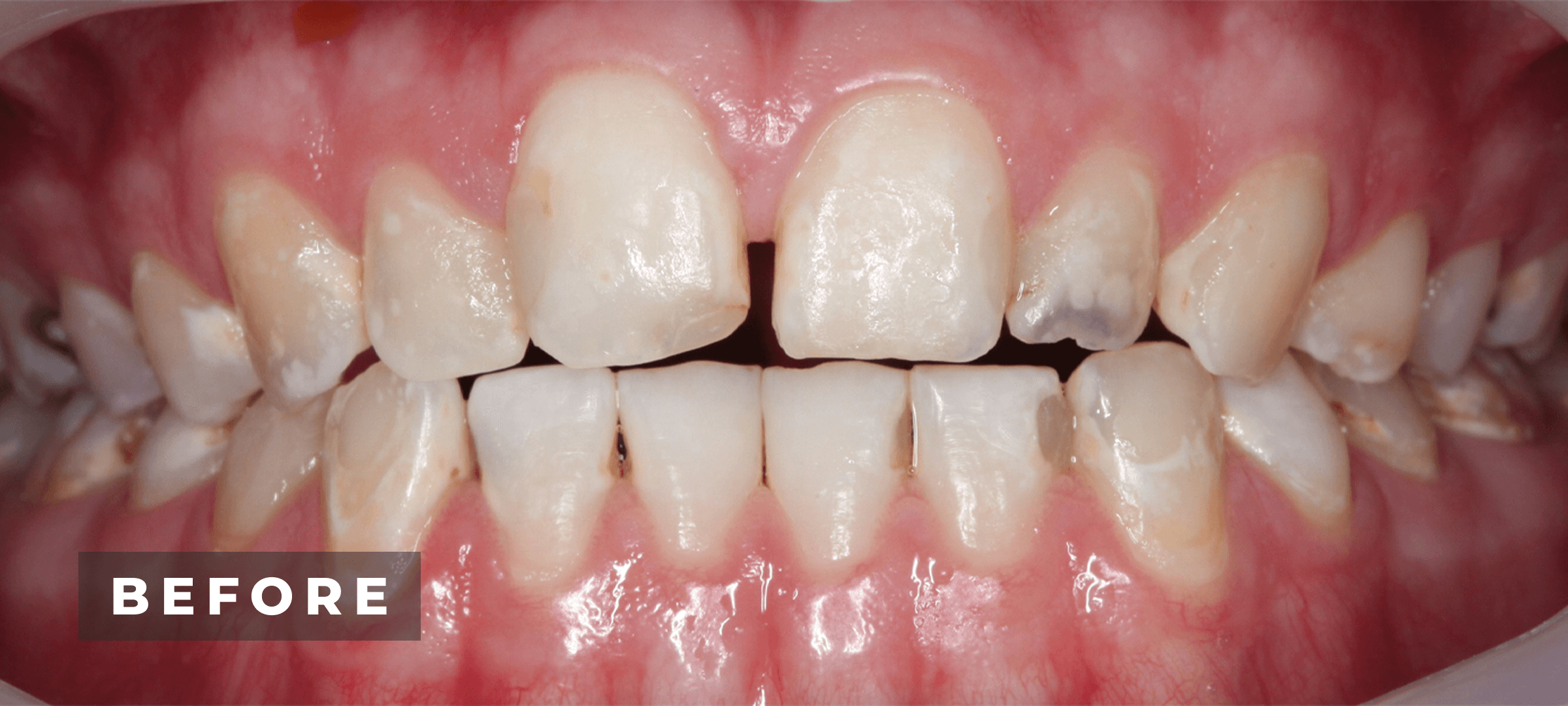 Before image of veneer & full mouth rehabilitation