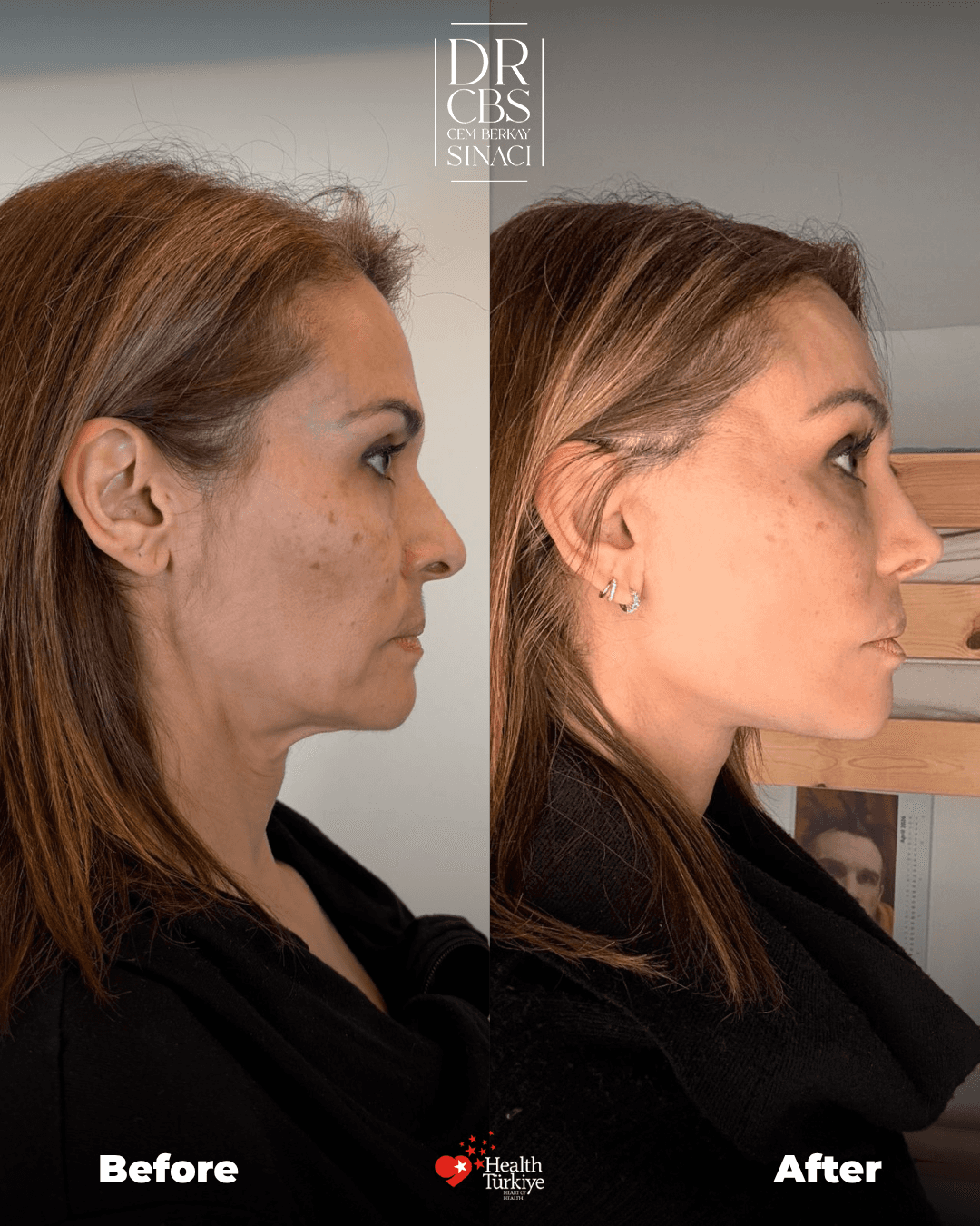 deep plane face neck lift and rhinoplasty before after right side view