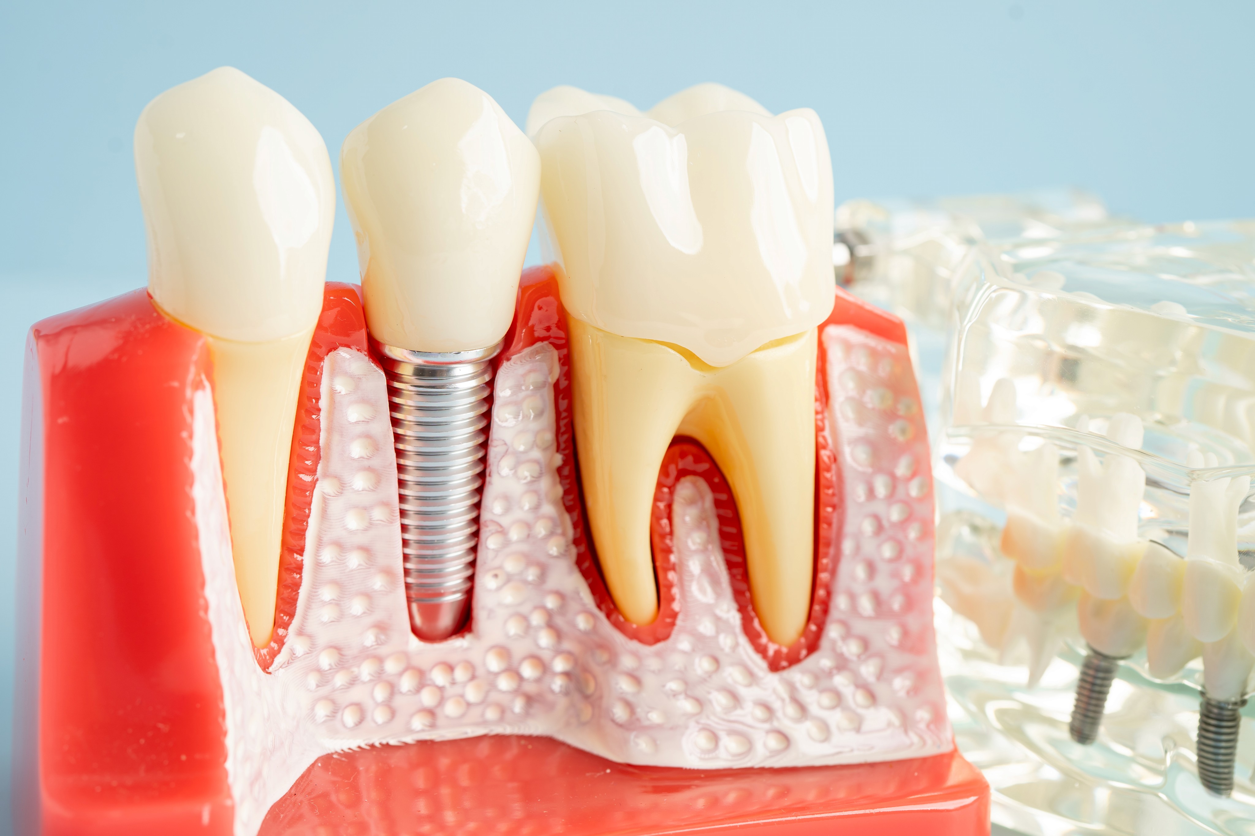 A dental model showcases a dental implant between two natural teeth, highlighting detailed gum and tooth anatomy against a light blue background.