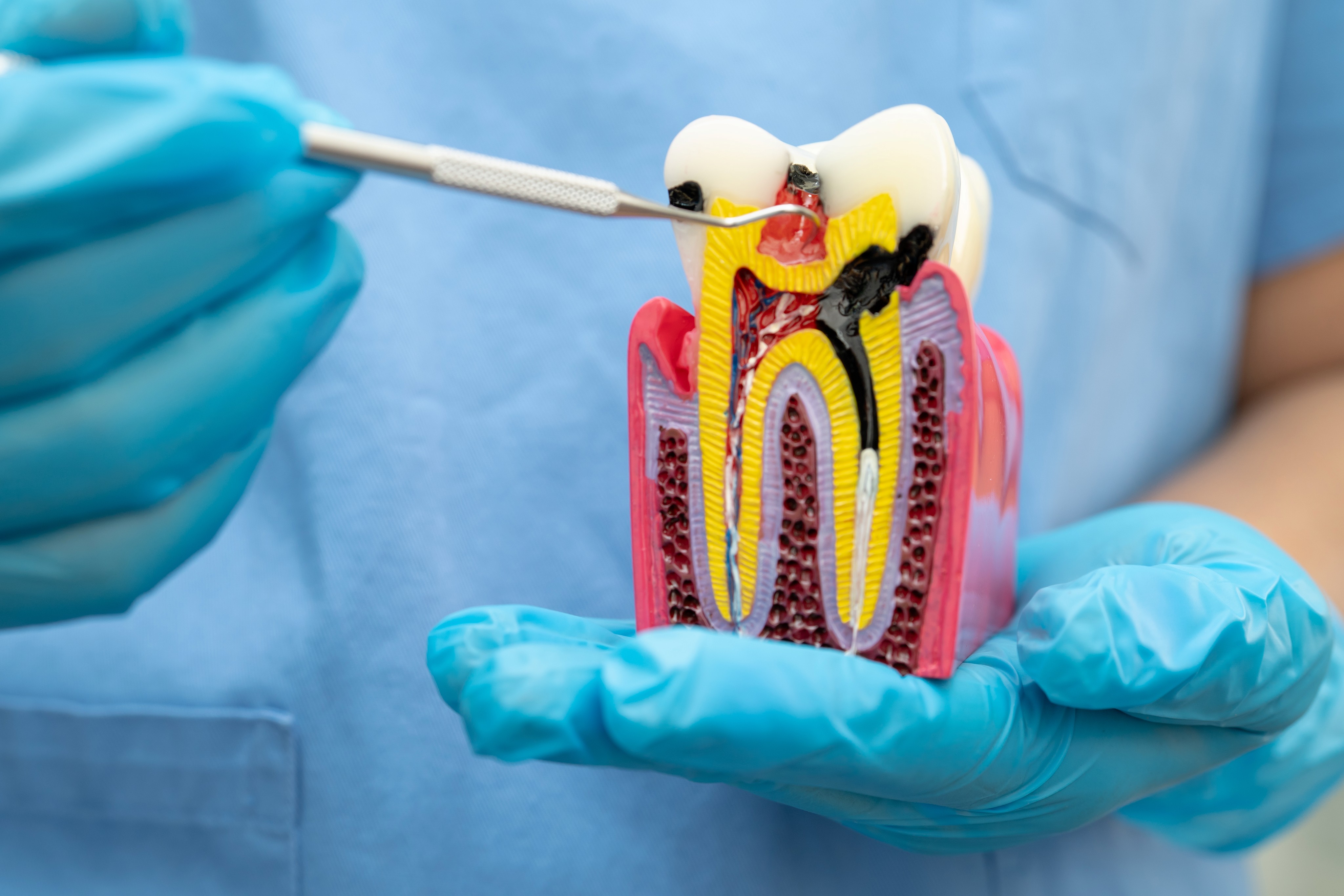 A dental professional in blue gloves holds a detailed model of a human tooth showing a cross-section with exposed pulp and nerves, illustrating the stages of a root canal procedure.