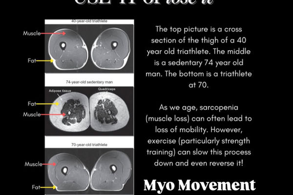 Sarcopenia article