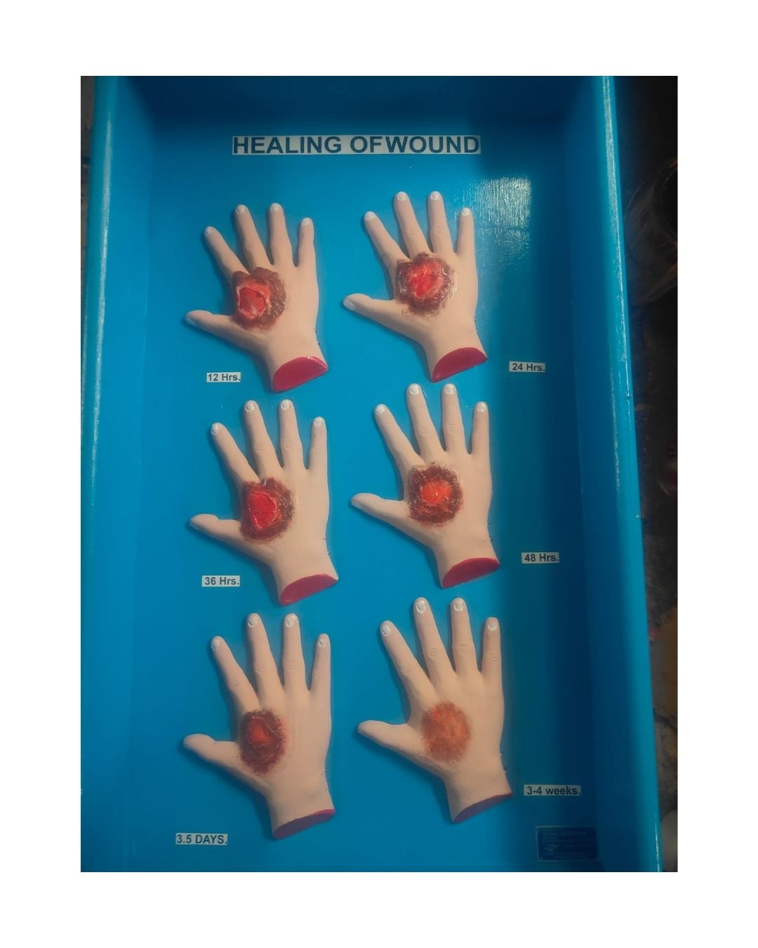 Healing of Wound – Stages