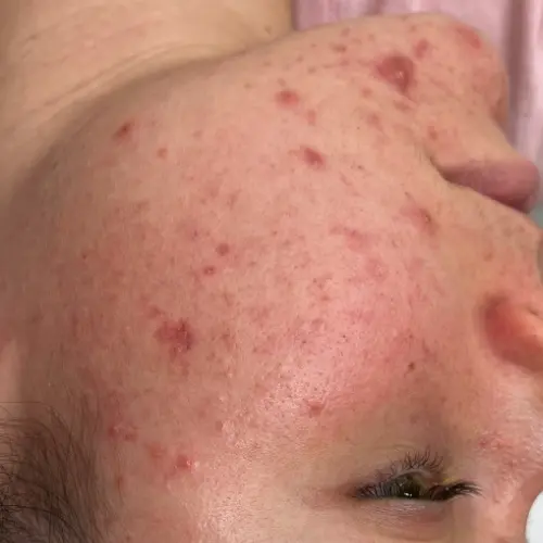 Before cryotherapy facial at The Vancouver Aesthetician — active acne, blackheads and congested skin prior to cold globe cryo therapy treatment