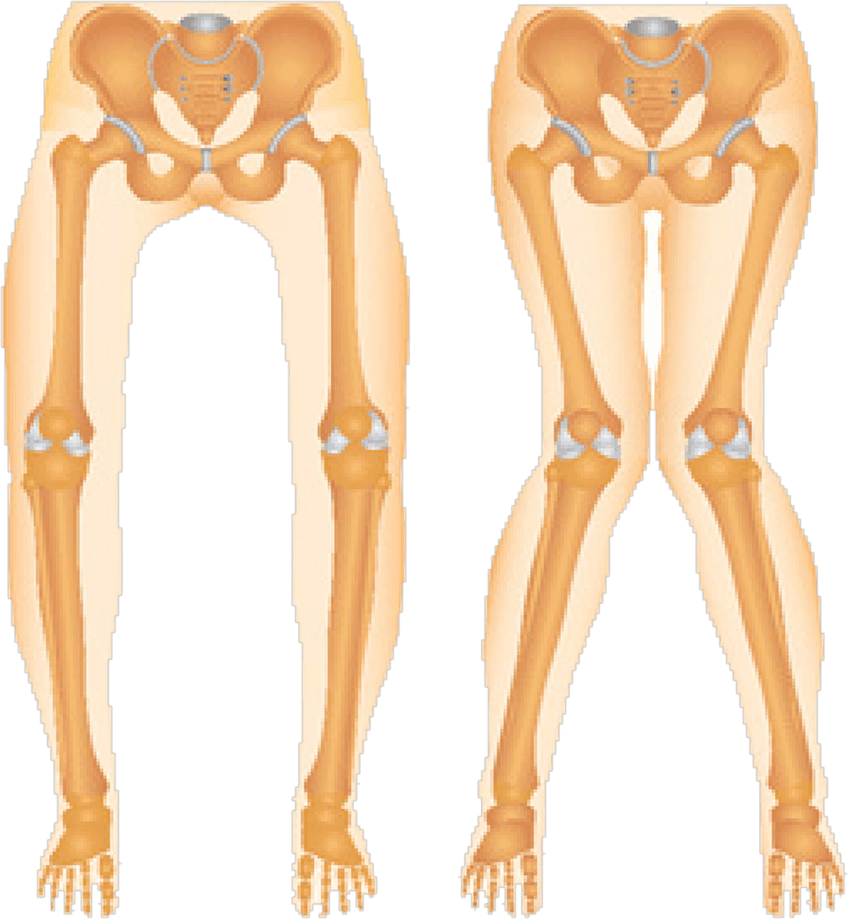 Two skeletal illustrations of the pelvis and legs side by side. On the left, bow-legged alignment with the knees held apart. On the right, knock-kneed alignment with the knees touching and the ankles apart.
