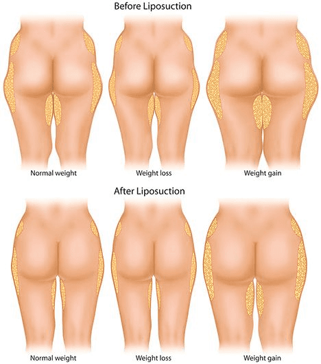 How Long Does Liposuction Last? Are the Results Permanent?