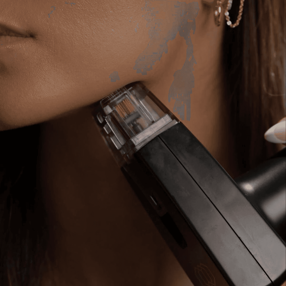 Morpheus8® en Terrasa, Heaven Clinics