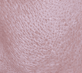 큐어젯과 쥬베룩을 이용해서 큰 흉터의 수복이 이루어진 후 사진 뷰티스톤의원 |  홍대피부과