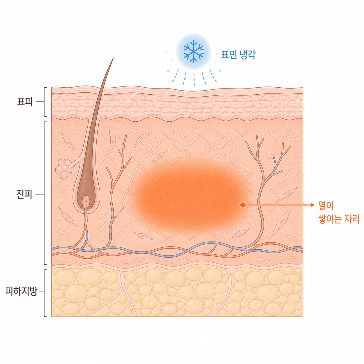 열이 쌓이는 자리는 표면이 아니라 진피 깊은 층이에요.