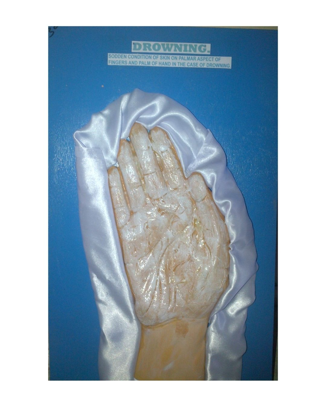 Drowning (Sodden Skin on Palmar Aspect)
