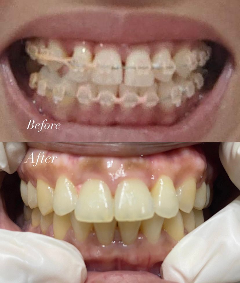 Sebelum dan Sesudah pemakaian behel ceramic