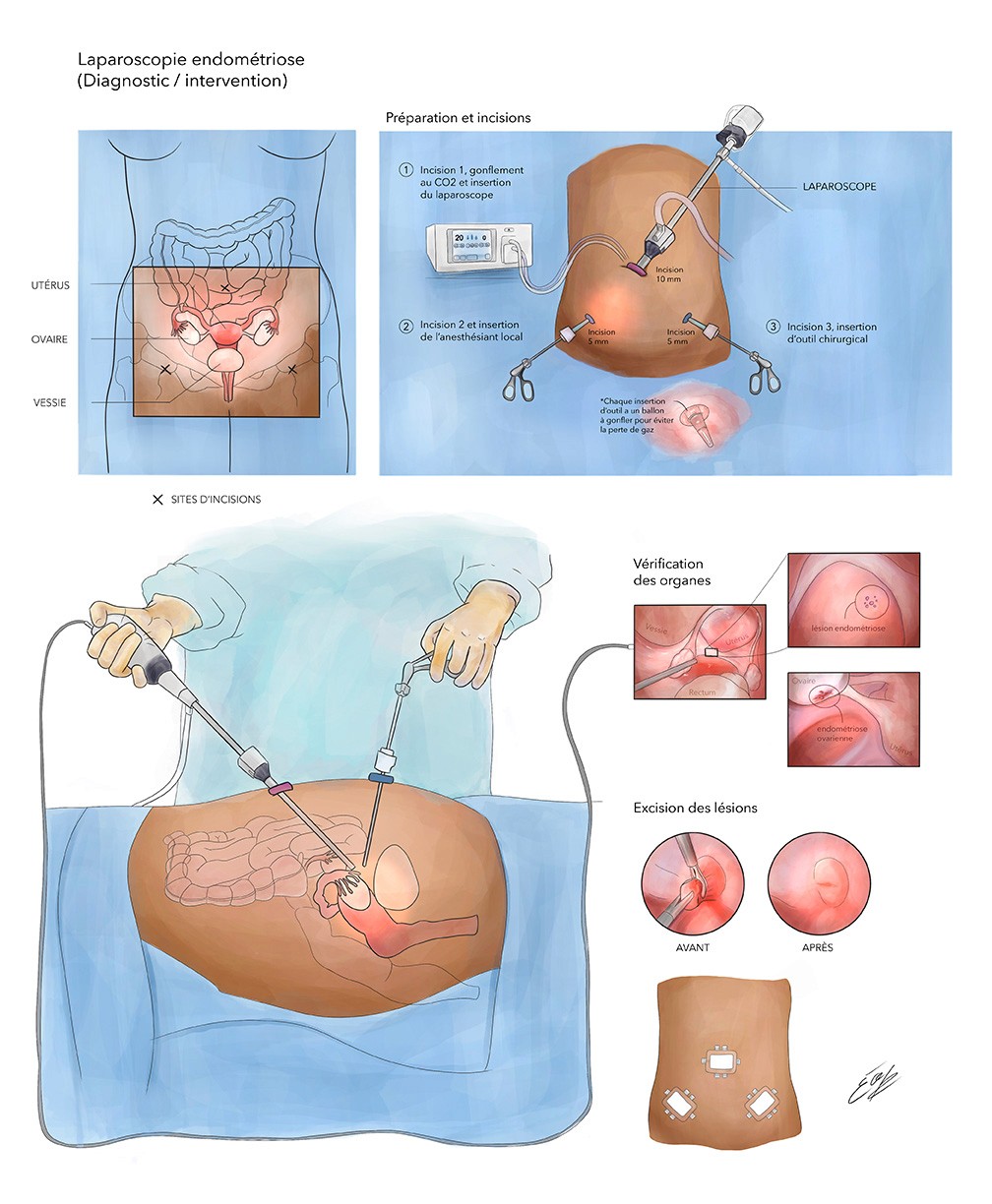Image de l'illustration d'Élodie Ouellet-Belleau d'une laparoscopie pour l'endométriose. Coin supérieur gauche montrant les structures anatomiques. Coin supérieur droite montre la préparation et l'insertion des intruments chirurgicaux. Le bas de l'illustration montre un ou une chirurgienne et les lésions d'endométriose qui sont excisées. Le tout est finalisé à l'aide de pansements.