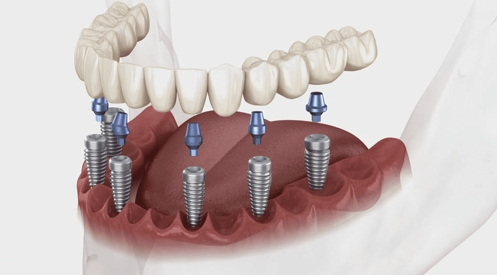 implantdentairerabathassan