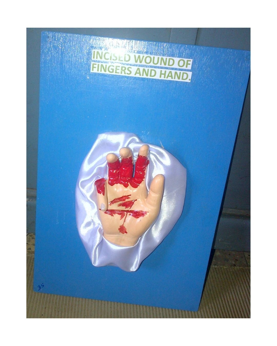 Incised Wound of Fingers and Hand