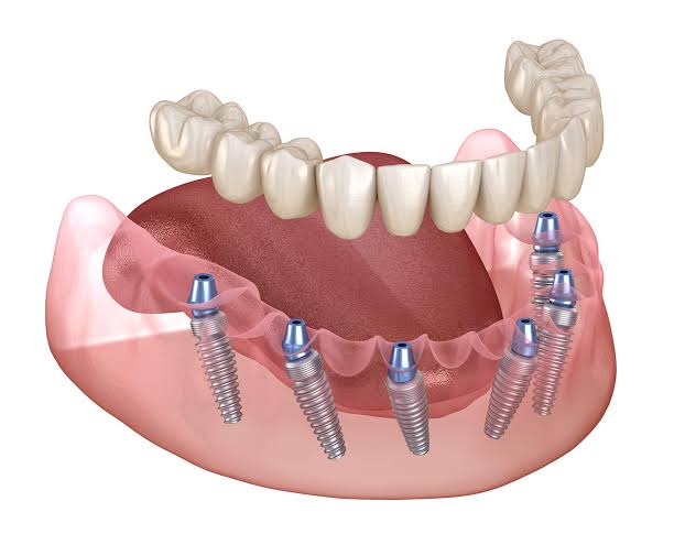 Patient placing a clear dental aligner over her teeth
