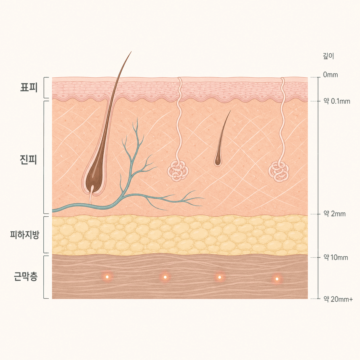 초음파 에너지가 깊은 근막층에 모이는 모습