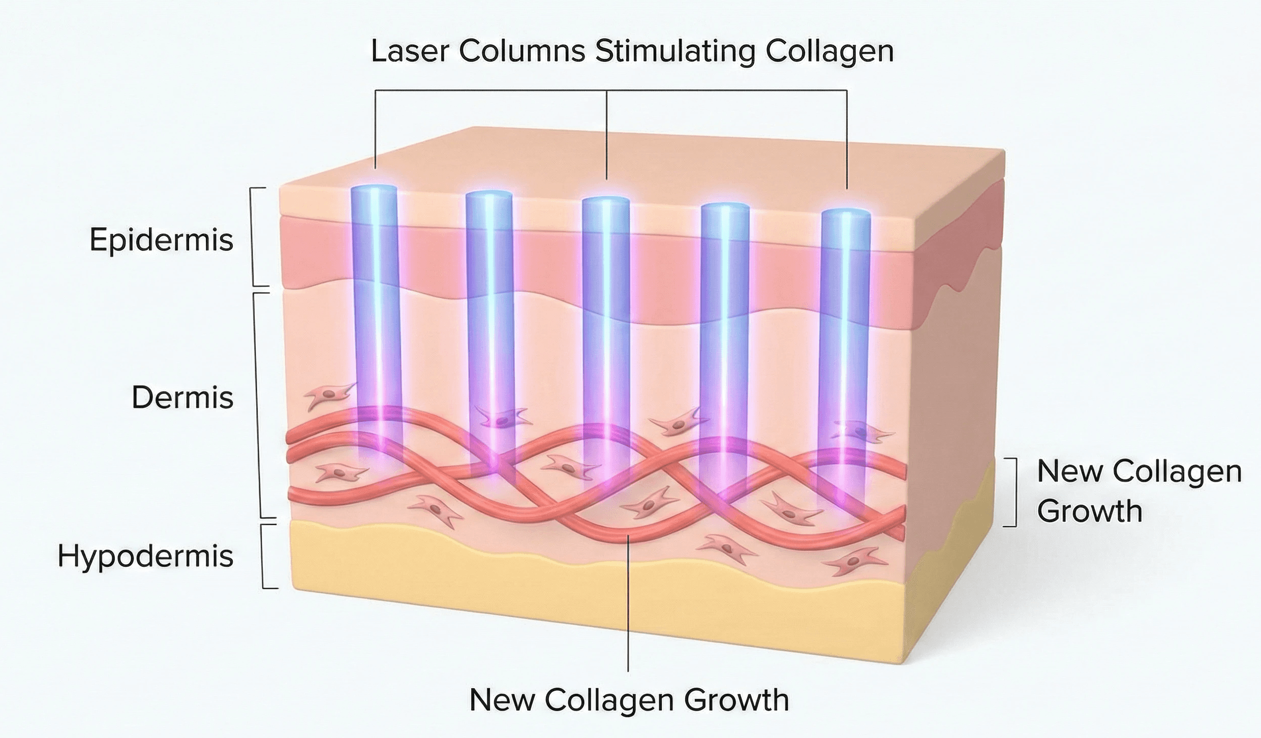 clean 3D cross-section diagram showing laser columns penetrating the dermis to stimulate new collagen growth