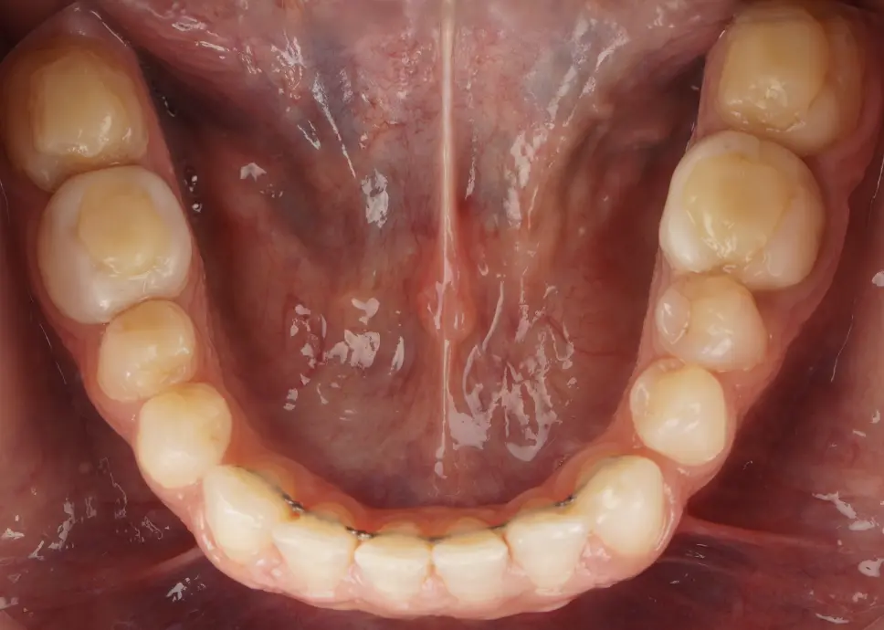 After ortho treatment
