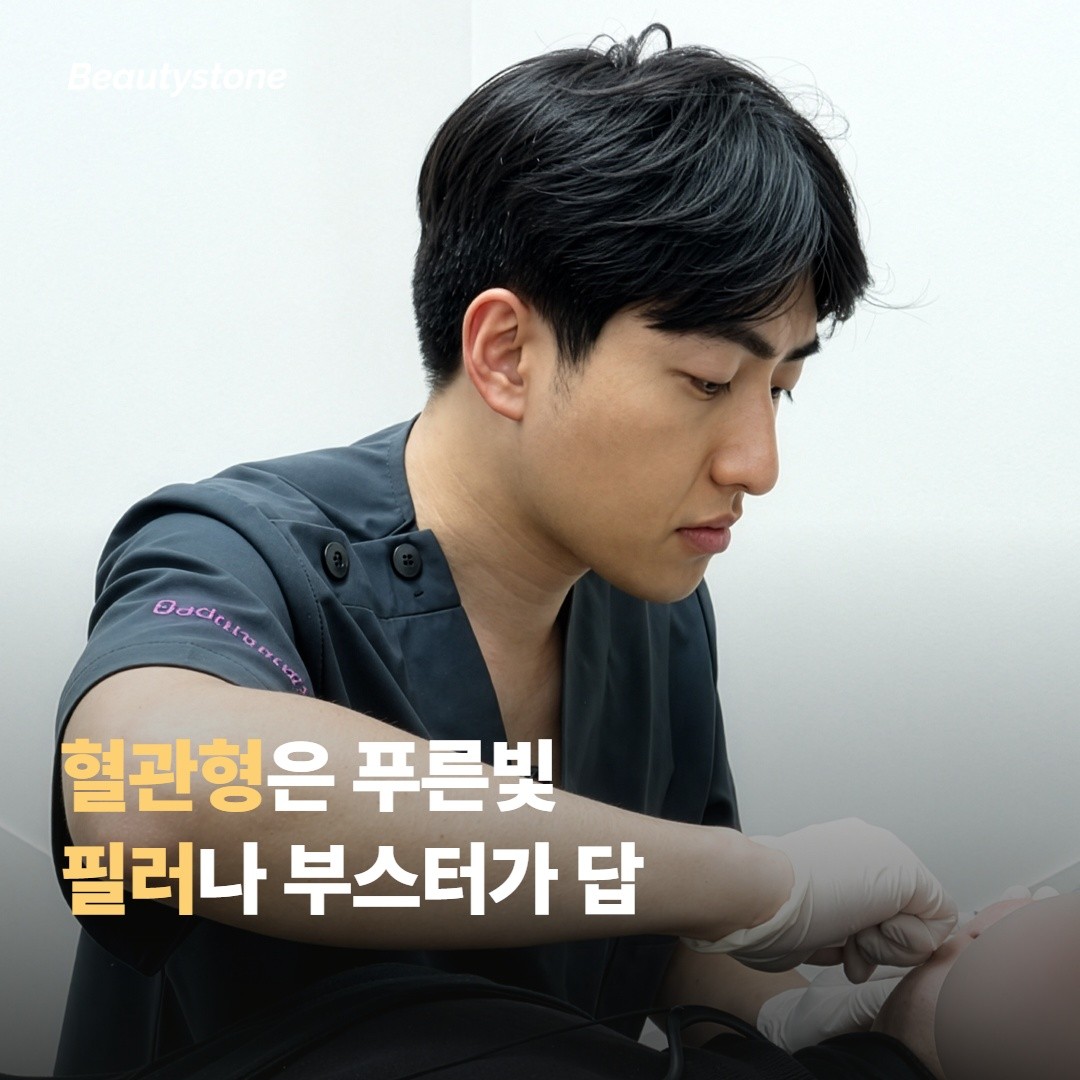 혈관형 — 푸르스름·보라색 다크서클