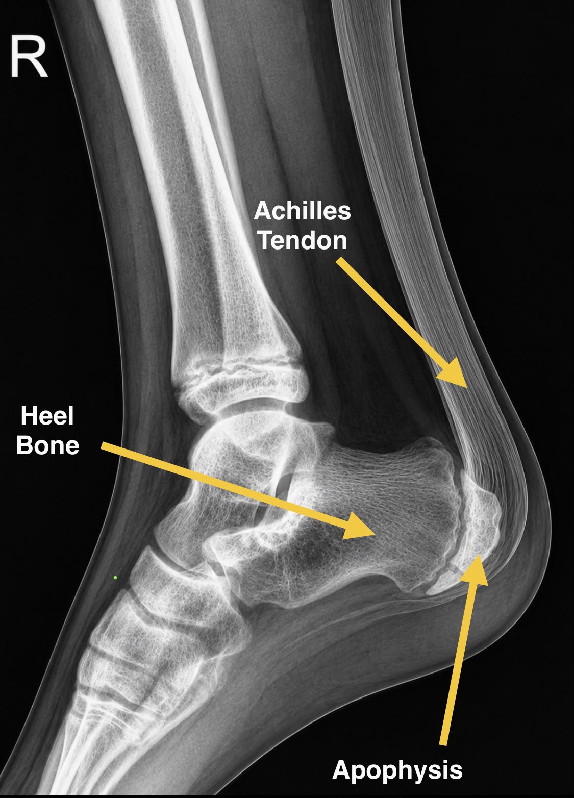 Side-view X-ray of a child's heel labelling the Achilles tendon, the heel bone and the growth plate (apophysis)
