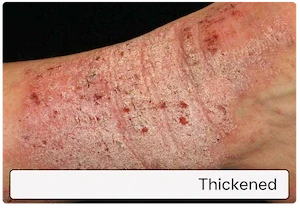 Thickened / leathery