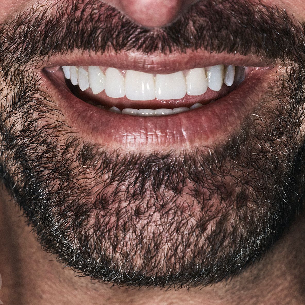 porcelain veneers