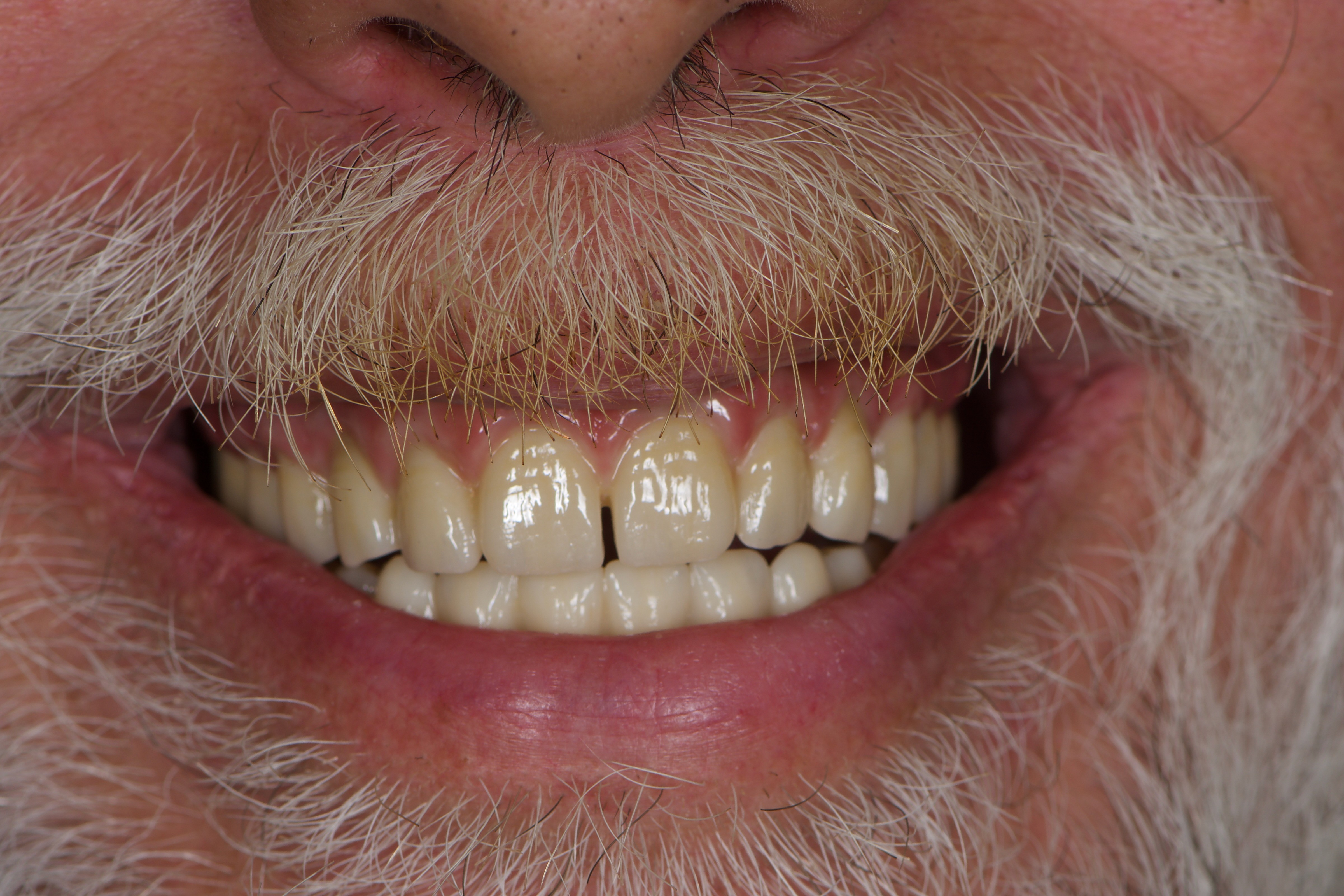 After full mouth rehabilitation at Bloor-Yorkville Periodontics