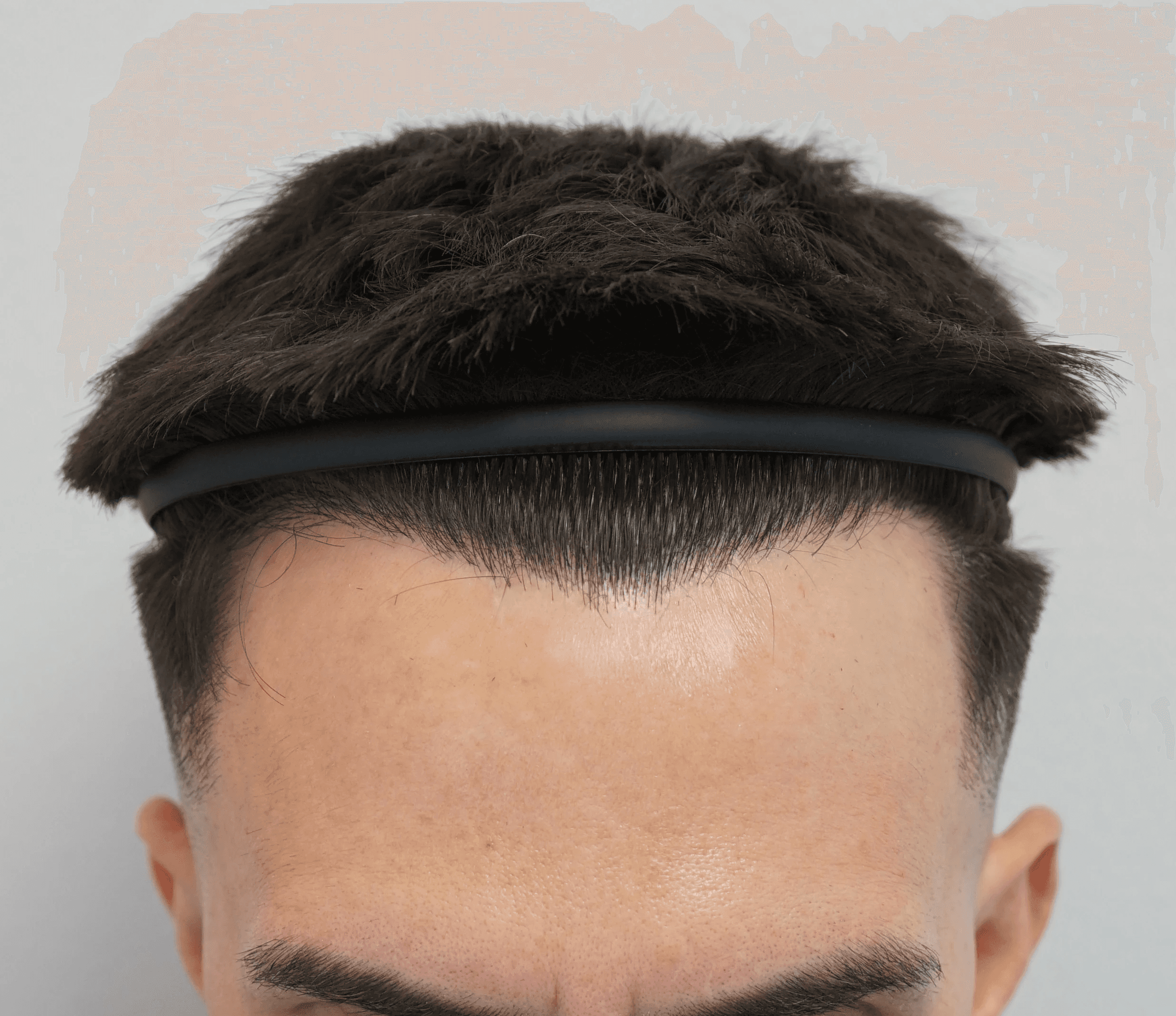 After hair transplant – Thomas's FUE Hair Transplant