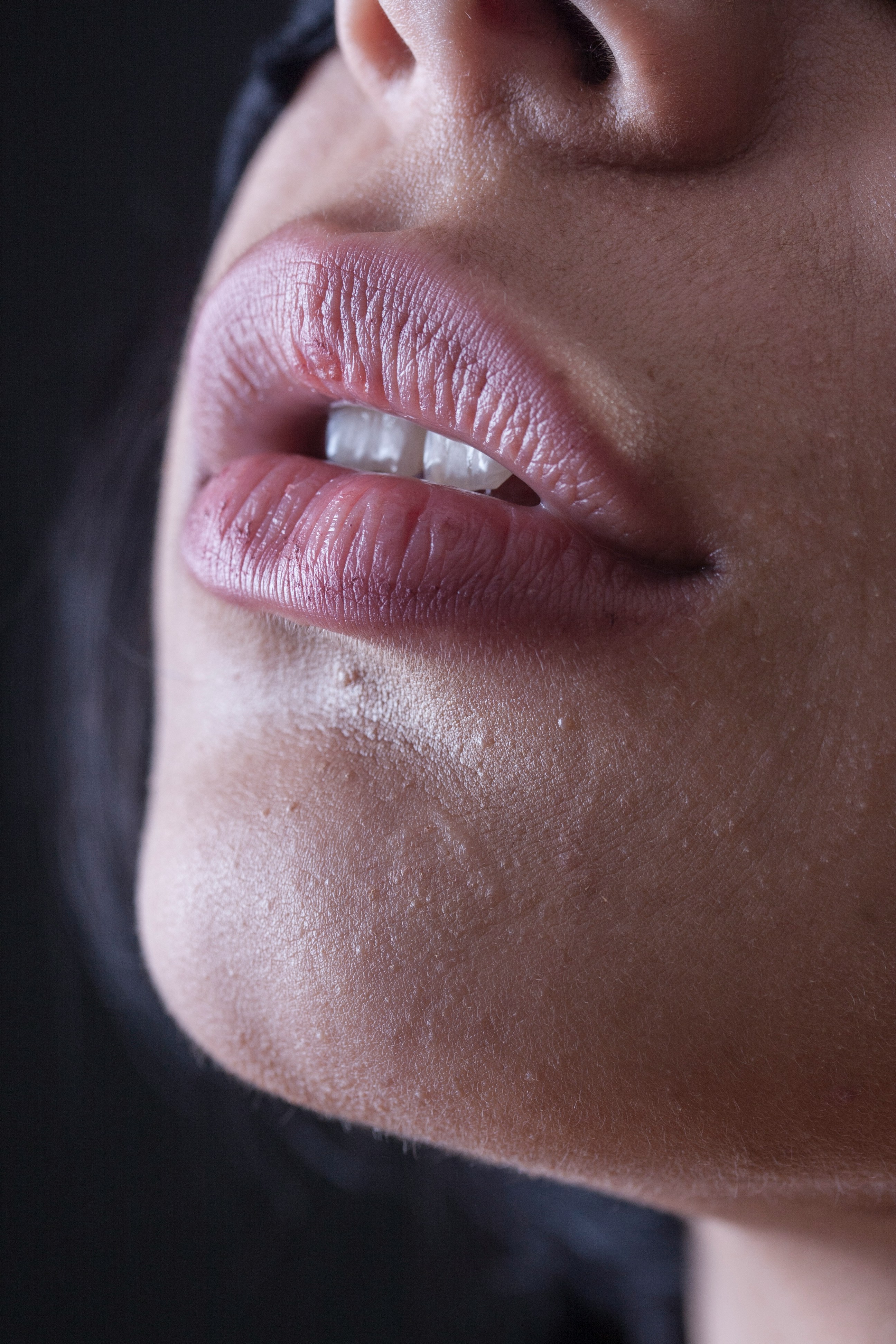 fillers treatment