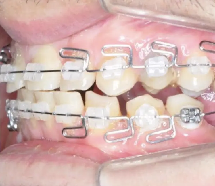 Trattamento funzionale con multi-loop edgewise archwires (MEAW) realizzati a mano 