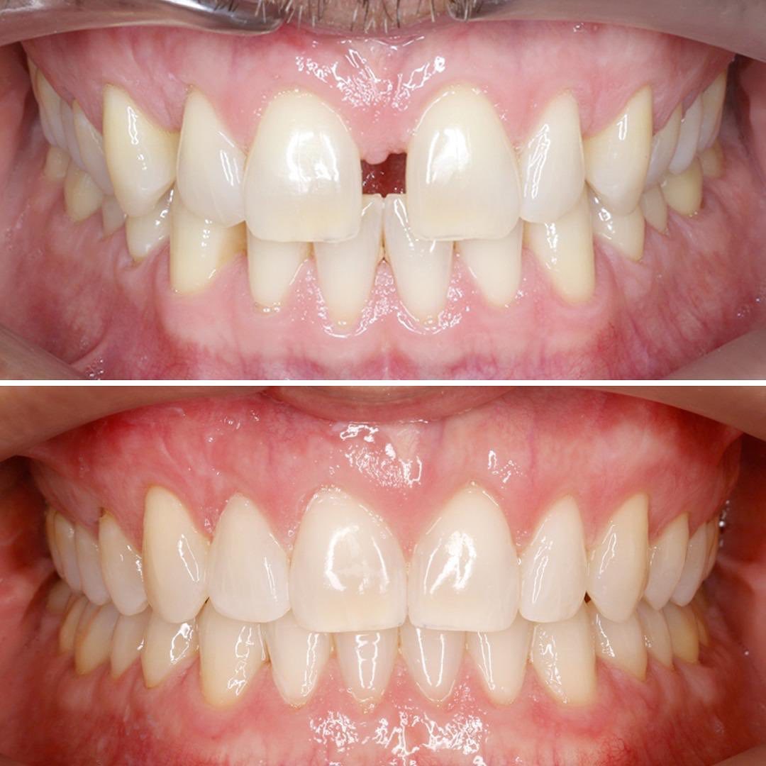 Invisalign® treatment showing before and after photos of teeth showing visible improvement in a wide gap between the front teeth.