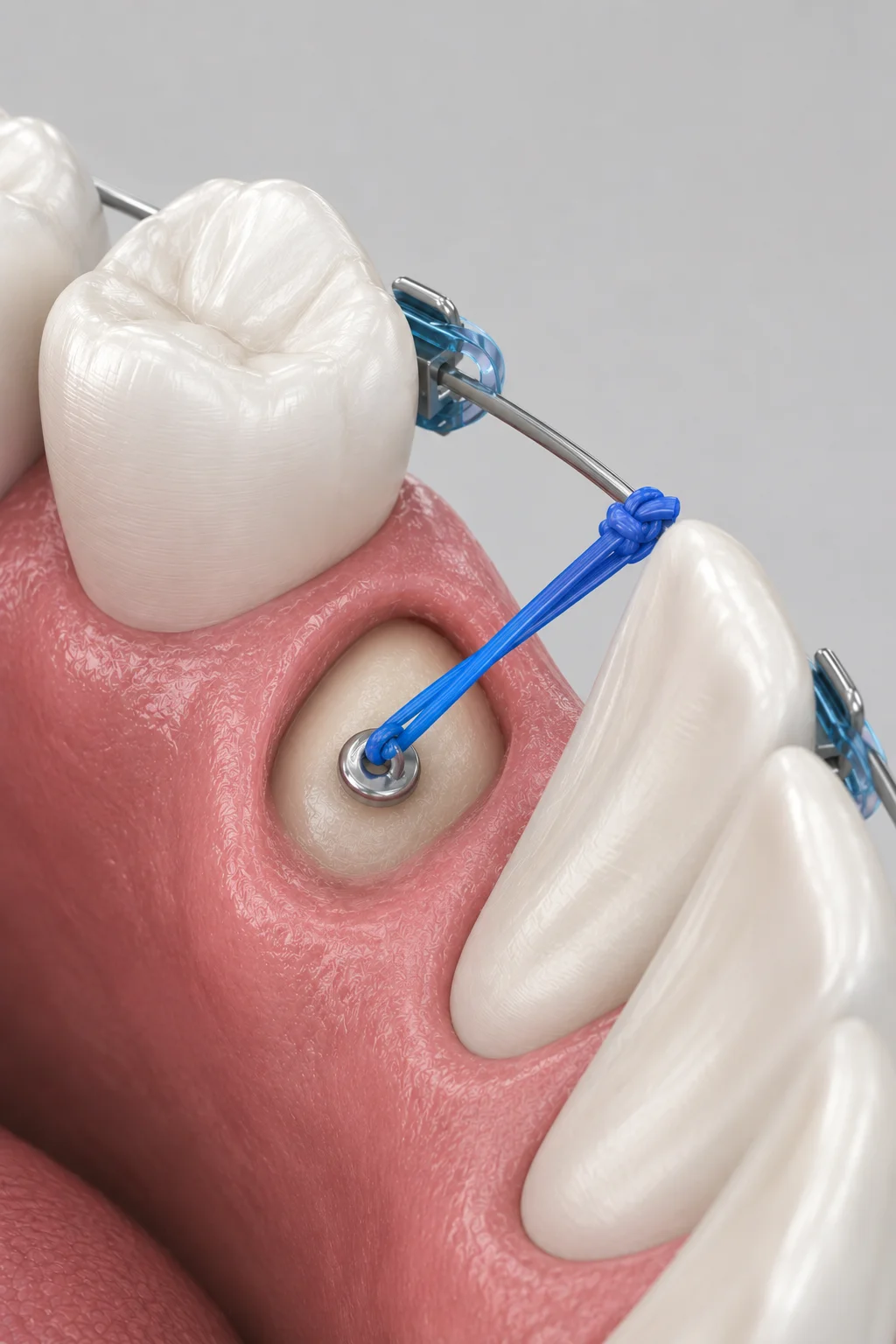 Medical illustration showing an expose and bond procedure used to guide impacted teeth into proper alignment.